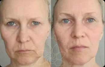 Wrinkles have smoothed out, the gaze has become more open, the facial contours have tightened, and the face looks younger.